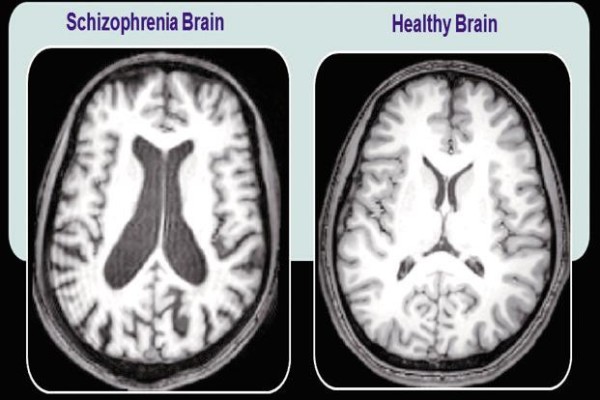 Sự khác nhau trong ảnh chụp cắt lớp vi tính ở não người bình thường và bệnh nhân Tâm thần phân liệt